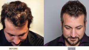 Nsync Singer Joey Fatone Decided To Address His Hair Loss And Undergo A Hair Transplant Poollandscaping Thinning Hair Loss Hair Loss Hair Restoration