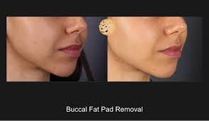 Lascia anche tu il tuo commento. Buccal Fat Removal Before And After Dr Nazarian Md