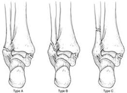 • deformity around the ankle • swelling • heamatoma • bony tenderness • instability and pain on. Ankle Fractures Broken Ankle Orthoinfo Aaos