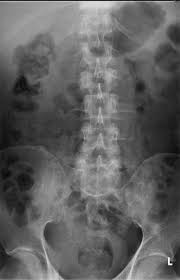 Although screenings for prostate cancer are one tool for early detecti. Vertebral Metastases Radiology Reference Article Radiopaedia Org