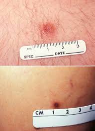 These include dermatofibromas, dermoid cysts, freckles, keloids, keratoacanthomas, lipomas, and moles. Common Benign Growths