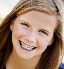 What dental insurance covers braces. Dental Insurance Ortega Orthodontics