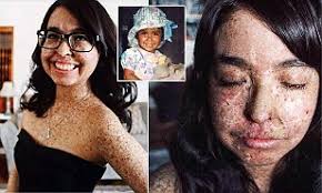 Xeroderma pigmentosum (xp) is defined by extreme sensitivity to sunlight, resulting in sunburn, pigment changes in the skin and a greatly elevated incidence of skin cancers. Woman Can Only Go Out At Night As She May Get Cancer If Exposed To Any Sunlight Daily Mail Online