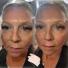 ✨She didn't want pillow face. She didn't want fake. She just wanted her  face… but fresher. ✨ For years, the lines above her mouth had been her  least favourite feature. This week,