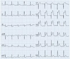 Subscribe to litfl via email. So Diagnostizierst Du Einen Herzinfarkt Klinik Via Medici