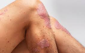 Image result for Auspitz Sign