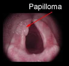 الثاليل التناسلية في الفم والحلق خطرها وكيفيه علاجها علاج الثاليل التناسليه