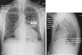 Normal chest x ray radiology case radiopaedia org. Imaging The Chest The Chest Radiograph Radiology Key