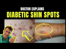 Image result for Pigment stains on the shin