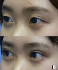 Before and After results from Upper Blepharoplasty! 📞Call (818) 986-7900  to book a surgical consultation for more information! • • • #blepharoplasty  #upperbleph #upperblepharoplasty #adrianyi #adrianyimd #encino  #uppereyelidsurgery #uppereyelid ...