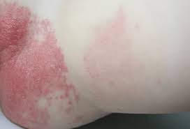 Dermatitis Del Panal Por Lucia Mi Pediatra Los Mejores Consejos Y Recomendaciones Para Tu Bebe