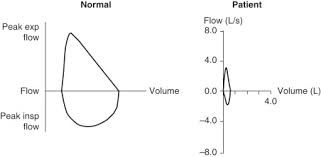 Forced Vital Capacity An Overview Sciencedirect Topics