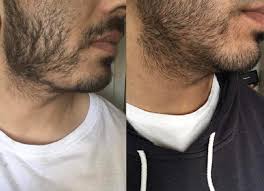 You won't be able to get that walrus style or tom selleck mustache for at least a few months. I Made A Post A While Ago How I Got This Bald Spot 2 Months After Using Minox Well About Half A Year Later Maybe More It Finally Regrew So If You Re Like
