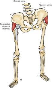 Image result for Functional Leg Length Discrepancy