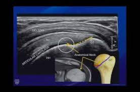 26 Ultrasound Of The Shoulder Youtube Ultrasound Ultrasound Sonography Sonography