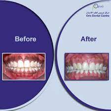 Gum Depigmentation Is A Process Used In Cosmetic Surgery To Remove Black Spots On The Gums That Are Caused By Excessive Amount Of Melanin We Use Laser Gum De