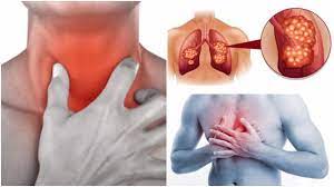 As is the case for many cancers, it's likely you won't notice symptoms until the lung cancer is in an advanced stage. Lung Cancer Signs And Symptoms Tagalog Symptoms Of Lung Cancer Or Chronic Obstructive Pulmonary A Cough That Doesn T Go Away And Gets Worse Over Time