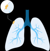 Stage 1 is the earliest stage of mesothelioma cancer and offers the best treatment options for patients. Mesothelioma Learn About Malignant Mesothelioma Cancer