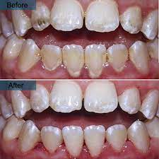 Maybe you would like to learn more about one of these? Dental Cleaning In Brooklyn Ny Professional Teeth Cleaning Near Me