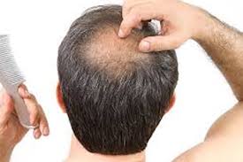 As per ayurvedic philosophy, hair loss is caused due to excess of pitta dosha in the body. Herbal Remedies For Ayurvedic Treatment Of Baldness Hair Loss