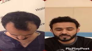 افضل مكان لزراعة الشعر في العالم Youtube