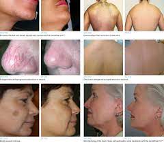 Mismon laser hair removal for women and men. Gentlemax Pro Laser Treatments Shades Valley Dermatology