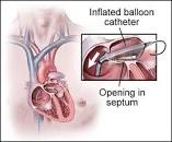 Image result for rashkind balloon atrial septostomy