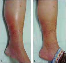 Image result for Lipodermatosclerosis