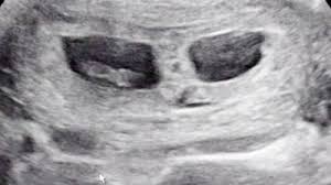 Im ultraschall kann man meist auch sehr gut erkennen, ob es sich um eineiige (monozygote) oder zweieiige (dizygote) zwillinge handelt. Zwillinge In Der 8 Woche Ssw7 Babywelten Ch