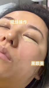 【黑眼圈，疤痕，妊辰纹改色术】