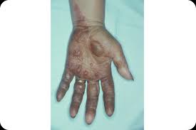 Image result for dermatitis contacta allergica