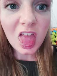 Increased pain when eating hot or cold foods/drinks. Gold Coast Woman Strangled Alive By Infection Caused By Impacted Wisdom Tooth 7news