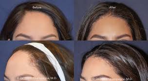 Another easy trick to make your forehead look smaller is opting for highlights. Hairline Lowering Beverly Hills Plastic Surgeon Dr Jason Champagne