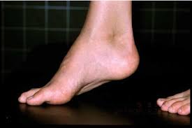 Congenital clubfoot (or talipes equinovarus) although different types of clubfoot exist, the condition is usually accompanied by the following foot deformities: Recurrent Clubfoot With Pes Equinus Adduction And Supination Download Scientific Diagram