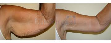 Pin On Cosmetic Surgeries For Body