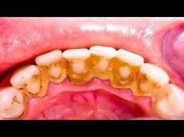 Countertop, flossing toothbrush, complete care, cordless How To Remove Tartar From Teeth Without Dentist In Hindi Teethwalls