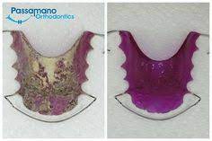 How to clean invisalign while in invisalign treatment will be a question on your oral hygiene. 7 Best Retainer Cleaner Ideas Retainers Retainer Cleaner How To Clean Retainers