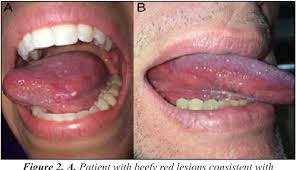 Image result for spinocellular carcinoma of the oral cavity