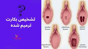 آیا ترميم بكارت قابل تشخيص است؟✓ 2 راه تشخيص بكارت ترميم شده