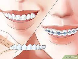 Maybe you would like to learn more about one of these? 4 Ways To Make Your Teeth Straight Wikihow