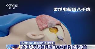 當腦機接口走進生活，會為我們帶來哪些新可能？-紫荊網