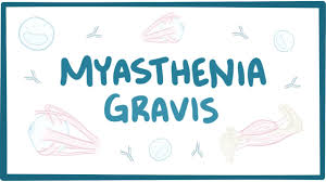 Open access maced j med sci. Myasthenia Gravis Causes Symptoms Treatment Pathology Youtube