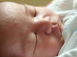 Check spelling or type a new query. Jerawat Pada Muka Bayi Baru Lahir Pada Badan 24 Foto Jerawat Hormon Setiap Bulan Putih Dan Merah Pada Bayi
