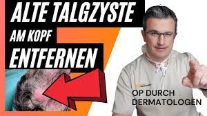 Alte Talgdruse Talgzyste Am Kopf Entfernen Dr Kasten Hautmedizin In Mainz Drkasten Youtube