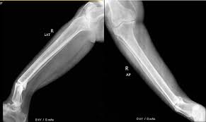 Image result for Tibia Stress Fracture