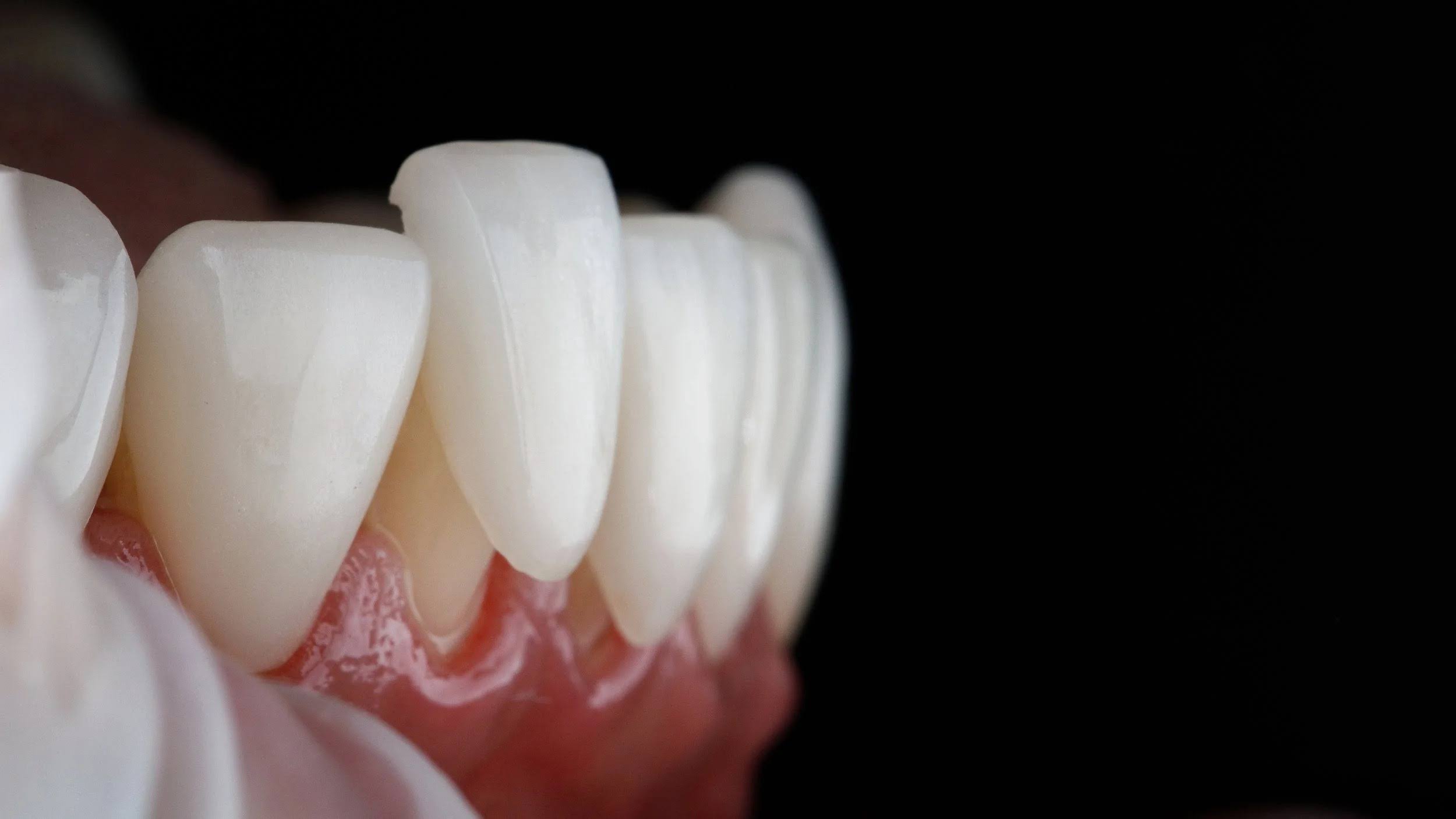 Veneers product image