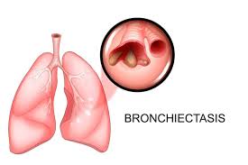 Image result for Bronchiectasis