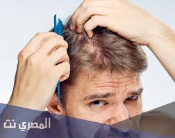 اسباب تساقط الشعر الشديد