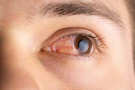 Image result for Vernal Conjunctivitis
