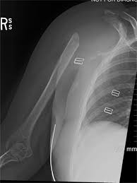 Image result for Shoulder Imaging